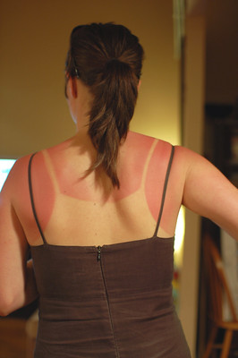 Sunburn